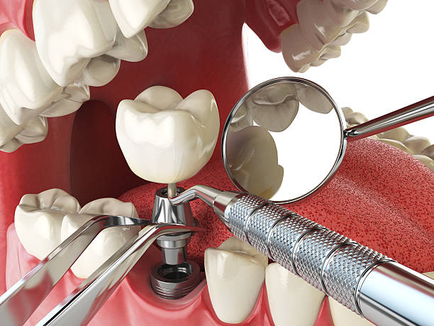 Best Emergency Wisdom Teeth Removal in Orange City, FL
